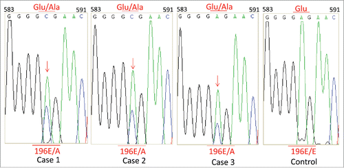 FIGURE 2. Graphic presentation of the sequencing analysis of PRNP. DNA sequence from the 3 patients at codon 196 shows a E to A heterozygous transition at codon 196 in one PRNP allele, leading to and exchange from Glu (E) to Ala (A). The right graph shows a control of DNA sequence of a person containing Glu/Glu homozygote at codon 196 in PRNP alleles.