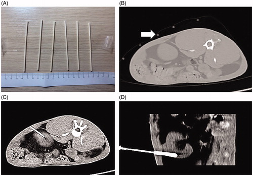 Figure 1. CT-guided implantation process. (A) Self-made positioning fence. (B) Self-made positioning fence (white arrow) displayed on a CT image. (C) The axial scan showed that the puncture needle had punctured into the lower pole of the kidney. (D) Coronal reconstruction indicates the full length of the needle and a more intuitive display of the needle tip position.