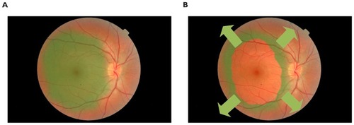 Figure 1 A schematic showing the theoretical mechanism of action. (A) posterior pole after staining, and (B) after ILM (internal limiting membrane)-rhexis, with vectors (arrows) of retinal relaxation after removal of ILM layer.