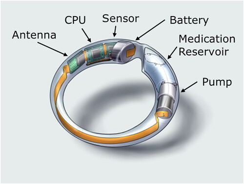 Figure 1. Illustration of the MedRing vaginal ring device.