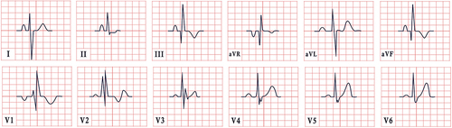 Figure 5 ECG features in pulmonary embolism. The ECG depicts the well-known S1Q3T3 pattern: S wave in lead I, Q wave in lead II and T-wave inversion in lead III. There is also right bundle branch block and pseudo-infarction pattern (Q waves in leads III, aVF).