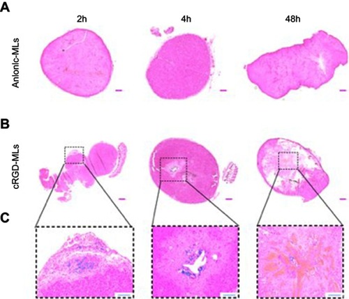 Figure 5 Hematoxylin and eosin stainings of tumors. Representative complete overviews of the histological sections of tumors derived from animals injected with either anionic magnetoliposomes (MLs) (A) or cRGD-MLs (B). (C) is an amplification of (B). The blue “dots” in the tumor, indicate the presence of Fe and are caused by the targeted uptake of cRGD-MLs. This signal is absent in the control tumors. Scale bar (A, B) =500 µm. Scale bar (C) =200 µm.