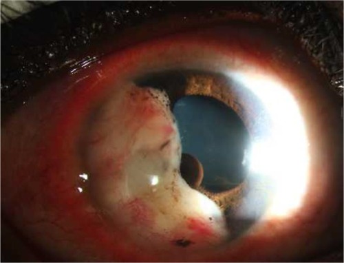 Figure 1 A well-circumscribed amelanotic iris mass with underlying multiple posterior pigment epithelial cysts.