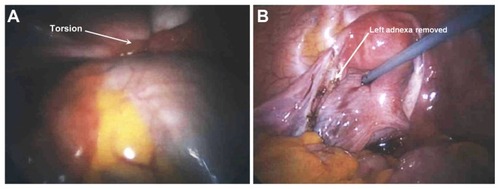 Figure 1 Panoramic view of the abdominal cavity. Left dermoid cyst torted × 3 (panel A). A view of the pelvis after removal of the left adnexa (panel B). The right adnexa appear normal.