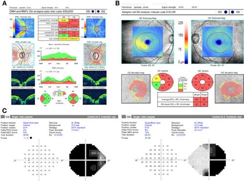 Figure 3 Structural and functional data of an example case of compressive optic neuropathy. A 54-year-old woman presented with slow progressive painless blur vision in the left eye for 4 months. (A) Peripapillary retinal nerve fiber layer thickness in superior, nasal, inferior, and temporal quadrants were used in the analysis; (B) macular ganglion cell-inner plexiform layer thickness in superonasal, superior, superotemporal, inferonasal, inferior, and inferotemporal sectors were used in the analysis; (C) Humphrey visual field test using 24-2 program shows junctional scotoma and mean deviation of −16.62 and −30.68 dB in right and left eyes, respectively.