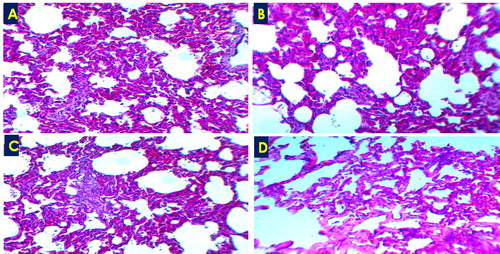 Figure 3. Acute interstitial pneumonia showed thickening of the alveolar wall due to leukocytic infiltration (A-C) and/or hyalinization (D), H&E ×100.