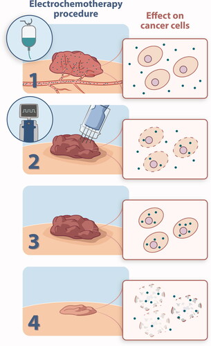 Figure 1. (1) Cutaneous tumours are identified for treatment and bleomycin is injected either intravenously (many or large tumours) or intratumourally. Bleomycin does not easily pass the cell membrane due to its hydrophilic and charged nature. (2) Electric pulses (400 V, 8 pulses of 0.1 ms) are applied to the tumour area, these pulses cause permeabilization of the cell membrane, thus allowing entry of bleomycin to the cell interior. The electrode is moved to cover the entire tumour volume with margins. (3) Bleomycin is now intracellular and can exert single and double strand DNA breaks, the cytotoxicity being enhanced several hundred fold after internalization. (4) Cell death ensues, most patients are treated only once due to the high efficacy.