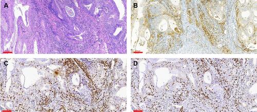 Figure 8 Detection of PD-L1, CD3, and CD8 expression in the tumor center by IHC. (A) H&E staining. (B–D) Positive staining for PD-L1 (B), CD3 (C), and CD8 (D). Scale bars: 60 μm.