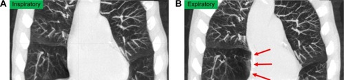 Figure 2 A 70-year-old male with COPD underwent dynamic-ventilation CT to evaluate central airway abnormalities.