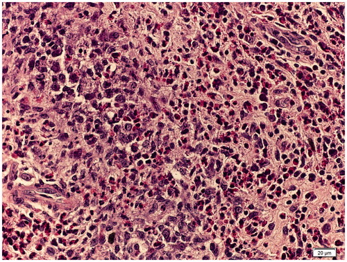 Figure 5. Clusters and sheets of histiocytes with ovoid to irregular nuclei, with fine or open chromatin and occasional distinct nucleoli, and infiltrating clusters of eosinophils.