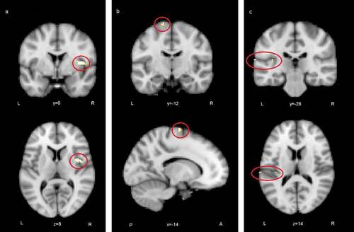 Figure 5. Regions where ISC analysis yielded highest statistics between groups (control > autistic): a) the right anterior insula, b) the left superior frontal gyrus, c) the left secondary somatosensory cortex and the posterior insula (FDR corrected)