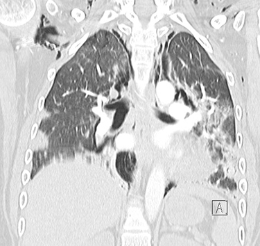 Figure 3 Coronal CT of the chest with contrast showing extensive pneumomediastinum and subcutaneous emphysema.