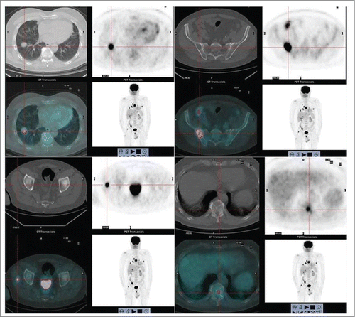 Figure 3. Total body 18 FDG- PET-CT performed at recurrence, demonstrating pathological hypermetabolism in pulmonary nodes and lymph nodes (SUV max 12.3), right gluteal muscle (SUV max 13.3) and diffuse bone involvement. Brain CT with iodine contrast was performed (not shown) and demonstrated no lesions.