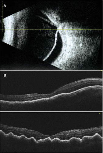 Figure 3 A 42 years-old monocular man with complex retinal detachment. (A) preoperative ocular ultrasonography: retinal detachment with advanced proliferative vitreoretinopathy. (B) postoperative optical coherence tomography after 4 months: macular reattachment with irregularities in the retinal pigment epithelium.