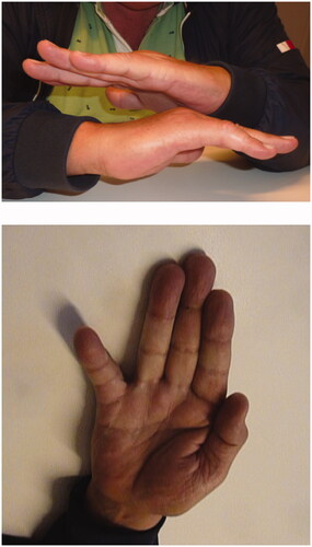 Figure 4. Photograph of the right hand at follow-up (6.5 months).