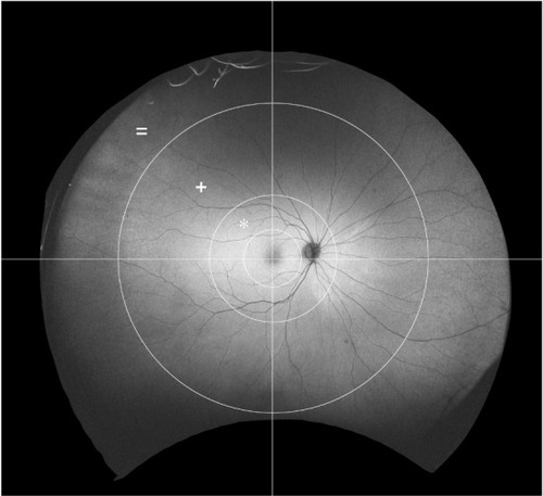 Figure 2 Novel grid to systematically grade peripheral abnormalities in age-related macular degeneration. The grid consists of three concentric circles and two lines. The central circle surrounds the macula area. The middle circle surrounds the perimacular area (*). The largest circle separates the mid periphery (+) from the far periphery (=). A vertical line through the fovea separates temporal from nasal quadrants. A horizontal line through the fovea separates superior from inferior quadrants.