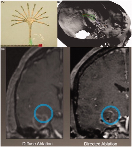 Figure 2. Flexible catheters and curved trajectories. (A) Third-generation variable stiffness catheter allowing high degree of flexibility due to multiple magnetically steerable segments. (B) Animation of a transforaminal curved trajectory allowing ablation of the left amygdala, hippocampus, PHG and entorhinal cortex through a minimal-invasive corridor preserving normal anatomy. (C) Postoperative MRI demonstrating difference between diffuse and directed ablation. (A) Adapted with permission from Chautems et al. [Citation63]; (B, C) Unpublished property of Dr. Joseph Neimat.