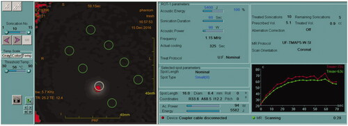 Figure 3. Insightec MRgFUS console display demonstrating a sonication of 5400 J (90 W, 60 s). Right bottom graph demonstrates a maximum temperature of 63 °C produced under these parameters. Green circles in the left panel indicate the locations of all 8 ablation targets, with the white circle indicating the target of the current sonication.