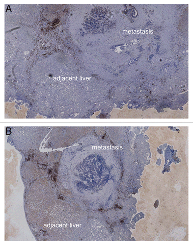 Figure 8. Homogeneity of synchronous hepatic metastases of colorectal carcinoma. (A and B) Overview image (2.5× magnification) of synchronous hepatic metastases of colorectal carcinoma stained for CD3+ cells. In this case, CD3+ cell infiltration in both metastases is comparable.