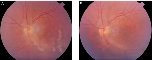 Figure 3 Patient 5 (Tables 2 and 3) with positive serology for Bartonella henselae and history of cat scratch, presenting with unilateral intermediate uveitis. A) before treatment and B) after 4 weeks treatment with ciprofloxacin: regression of uveitis (the absence of snowballs is notable).