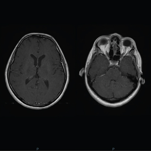 Figure 2. Similar imaging findings on brain MRI were noted 4 days later.