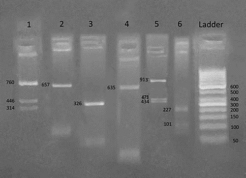 Figure 2. Heterozygous Benin/Bantu βS haplotype (----++)/(+----+). An agarose gel electrophoresis of RFLP analysis by Hind II 5′ to ε gene demonstrates positive heterozygous result (+/−) in number 1, XmnI 5′ to Gγ gene demonstrates homozygous negative result (−/−) in number 2, Hind III within IVS II Gγ gene demonstrates homozygous negative result (−/−) in number 3, Hind III within IVS II Aγ gene demonstrates homozygous negative result (−/−) in number 4, Hind II 3′ to ψβ gene demonstrates positive heterozygous positive result (+/−) in number 5, Ava II within IVS II β gene demonstrates homozygous positive result (+/+) in number 6.