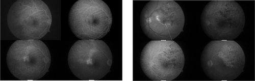 Figure 2 Fluorescein angiograms demonstrating bilateral branch vein occlusions with left macular edema.