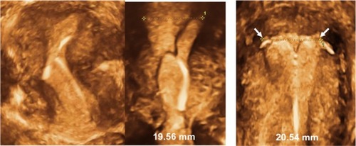 Figure 8 3-D ultrasonography: Abnormally located ParaGard intrauterine device (IUD) causing bleeding and pain (left) and middle (Mirena). Even if the IUD is apparently located in the correct position, the too-long transverse arm can cause painful contractions (right).