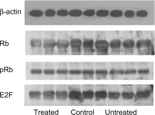 Figure 7 Western blot analysis of Rb, pRb, and E2F expression in cancer cells.