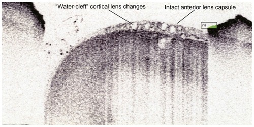 Figure 2 Visante™ anterior segment optical coherence tomographic image demonstrating an intact anterior lens capsule and anterior subcapsular vacuolar cataractous changes.