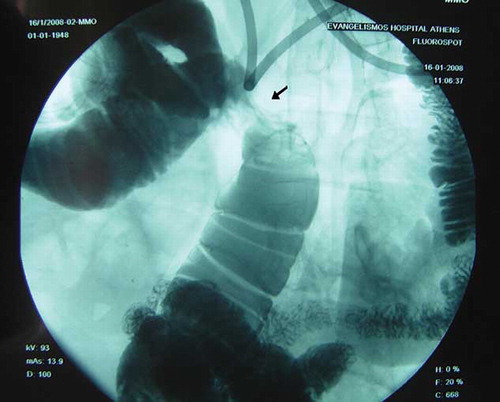 Figure 2. Small intestine transit study. A marked stricture is shown in the middle of the picture (arrow).