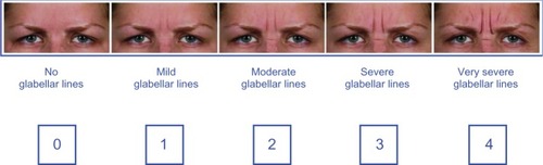 Figure 1 The validated Merz 5-point scale for glabellar frown lines at maximum frown.
