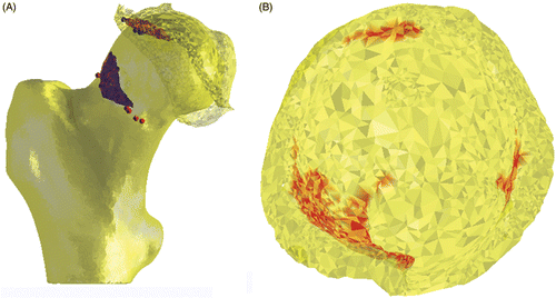 Figure 2. (A) Description of femoral and acetabular contact points in relation to the location and size of the cam lesion, and (B) identification of the intra-articular collision area and contre-coup area for evaluation of cartilage at risk for shear damage during specific motions (red areas). This particular example represents a simulation for flexion in a clinical case of FAI.