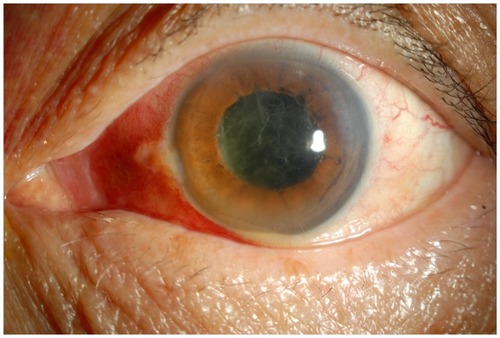 Figure 3 An image of the anterior chamber of case 4 on postoperative day 4. Hypopyon and fibrin have developed in the anterior chamber.