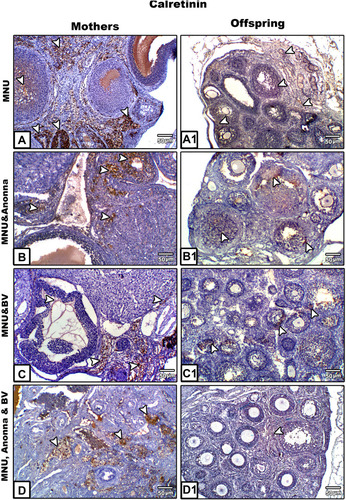 Figure 5 Microscopy of paraffin-embedded sections of mothers' ovaries (A–D) and their offspring (A1–D1) stained with anticalretinin antibody. Ovarian tissue shows a strong positive reaction for calretinin protein in MNU-induced mother rats (A), moderate to weak reaction in graviola juice–supplemented mothers (B), weak to negative calretinin reaction in BV-treated mothers (C), and moderate to weak calretinin expression in A. muricata juice plus BV–treated mothers (D). Ovarian sections of offspring displayed moderate calretinin expression in MNU-induced group (A1), weak calretinin reactivity in A. muricata juice or BV (B1 and C1), respectively, and very weak or negative calretinin expression in A. muricata juice and BV–supplemented offspring (D1). Arrowheads indicate immunoreactivity of calretinin.