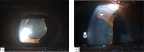 Figure 1 (A)Dilated pupil in the right eye, glaucomflecken, and (B) patent peripheral iridectomy in the right eye.