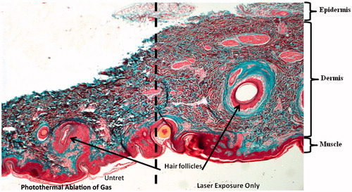 Figure 6. Ex vivo porcine skin to which a cylindrical volume of GAS and nanotubes was secured on the left hand side of the image and the GAS photothermally ablated. Dermal skin cells are observed as light pink and red, while collagen fibres were stained blue. Tissue shrinkage and coagulation of collagen and cell death are observed on the left side adjacent to photothermal ablation. Thermally denatured collagen stains deep red instead of blue and is indicative of tissue damage.