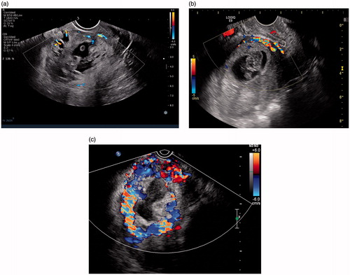 Figure 6. Grading of the blood signal on color Doppler flow imaging (CDFI) of uterine lower segment: (a) CDFI grade 1, very little blood signal; (b) CDFI grade 2, moderate blood signal; (c) CDFI grade 3, rich blood signal (from the same patient of Figure 3).