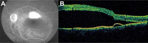 Figure 41 Central serous chorioretinopathy.