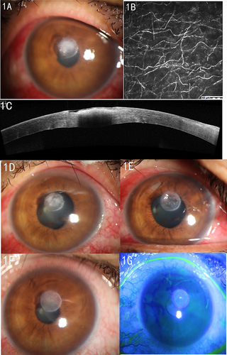 Figure 1 Pre-and post-operative conditions of patients undergoing low-temperature plasma. (A) Pre-operative slit-lamp examination shows unclear boundaries of corneal ulcers, hyphae coat, and formed pseudopodia around ulcers; (B) a large number of crisscross highly reflective fungal hyphae were seen under a pre-operative corneal confocal microscopy; (C) pre-operative anterior segment optical coherence tomography (OCT) indicates local infiltration of corneal epithelium and the lesion range of less than 1/2 corneal thickness; (D) the slit-lamp examination on postoperative Day 1 shows that the ulcer area was brighter than before; (E) the slit-lamp examination on the postoperative Day 3 shows mild corneal edema with a clear boundary; (F and G) the slit-lamp examination at postoperative Week 3 shows the ulcer focus became lighter and thinner, with clear boundary; after sodium fluorescein staining, the corneal epithelium was not stained and the ulcer was completely scarred.