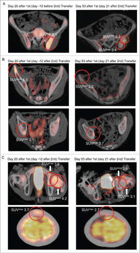 Figure 4. PET-CT FDG-uptake reduction in multiple bone sites after second adoptive transfer. After second adoptive transfer, prior PET-CT positive sites (left panel) at the (A) left iliac spine, (B) right iliac spine and right acetabular roof, as well as (C) left femoral neck, left acetabular piller, and calvarium showed significant regression with respect to metabolic volume and SUVmax (right panel).