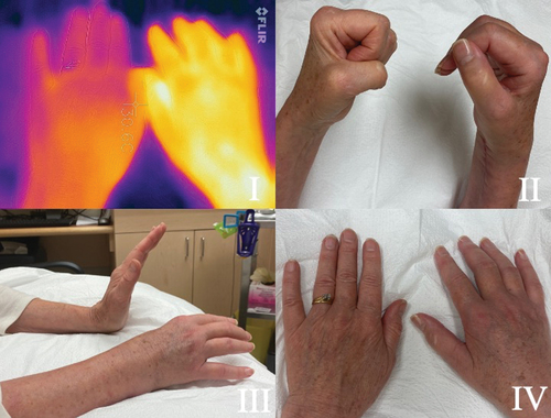 Figure 1. (a) A 64-year-old female presented two months after ORIF for a distal right radial and ulnar fracture. There is involvement of the wrist and all fingers. I. FLIR ONE imagery of the dorsal aspect of each hand shows temperature asymmetry. The affected side is notably warmer than the unaffected. A II,III, IV show the reduced range of motion and swelling of the joints. (b) After three weeks on prednisone. The temperature on FLIR imaging (1BI) , swelling and range of motion (1B II III) have improved. The wasting of the first dorsal interossei (FDI) (1B IV) and weak intrinsic muscles is now apparent. Nerve conductions reveal the ulnar nerve has a small amplitude of 3mV, with no slowing at the elbow. The ulnar sensory was normal. The EMG to the FDI showed florid denervation, with no motor units recruiting. The adductor digiti minimi had 2+ denervation with reduced polyphasic recruitment, while the flexor carpi ulnaris was normal. Ulnar nerve entrapment at the wrist was diagnosed. Ulnar nerve decompression was performed at the wrist. Full resolution of all symptoms was achieved.