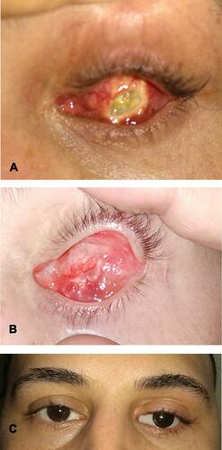 Figure 6 (A) Postoperative photograph shows central dermal ulceration 10 weeks postoperative (electrocoagulation). (B) After complete healing (after 28 weeks). (C) The prosthesis is fitted before complete healing.