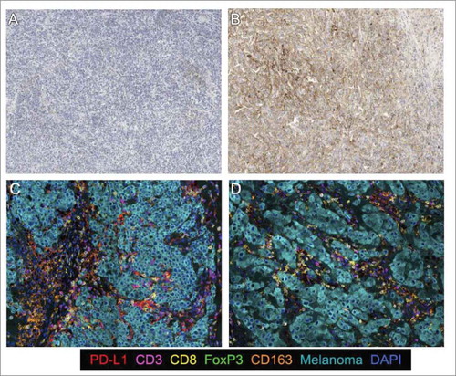 Figure 4. Immunohistochemical stain for melanoma tumor samples. PD-L1 chromogenic staining. a) Tumor with low PD-L1 expression and b) Tumor with high PD-L1 expression; Multiplexed IHC for the following markers: PD-L1, CD3, CD8, FoxP3, CD163 and Melanoma cocktail and DAPI as a counterstain; c) Short survival (PD): high CD8/CD163PDL1 and CD8/FoxP3 expression. d) Long survival (CR): low CD8/CD163PDL1 and CD8/FoxP3 expression;