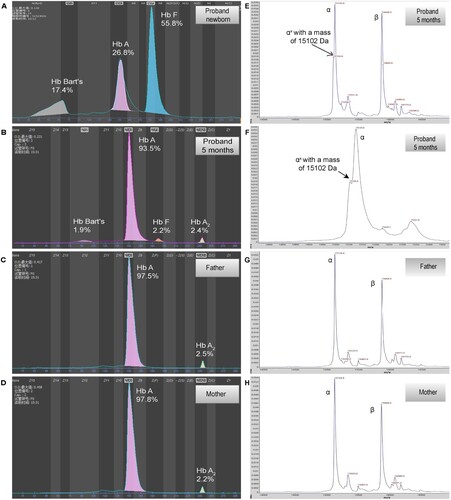 Figure 1. Hemoglobin patterns from capillary electrophoresis (CE) and MALDI-TOF. By CE, a Bart’s level of 17.5% and 1.9% was identified in proband at newborn (A) and 5 months (B), respectively. No abnormal peak was identified in father (C) and mother (D). By MALDI-TOF, a normal α chain at 15,127 m/z and an abnormal α chain (αX) at 15,103 m/z were identified in proband (E and F, the peak of abnormal α chain is zoomed at F), the abnormal α chain was not identified in father (G) and mother (H).