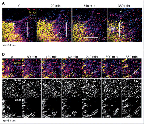 Figure 2. Tumor cells of pancreatic carcinoma migrate as mesenchymal cells. Time-lapse intravital imaging of a fluorescent mouse model of pancreatic cancer with tumor cells shown in yellow, collagen I in magenta, intravenously injected 70 kD Dextran in red and nuclei in blue. (A) Example of an imaging field (showing 4 time points (120 minute interval)), in which polar and elongated single cell migration was observed (boxed area is enlarged in B). Scale bar, 50 µm. (B) Boxed area in (A)showing an example of an imaging field (7 timepoints (60 minute interval) with migrating polar and elongated single tumor cells (example in circle) with a track (last timepoint, white line). Separate channels show the nuclei (Hoechst) and tumor cells (YFP), indicating that the particles that migrate contain nuclei. Scale bar, 50 µm.