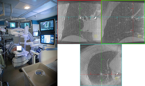 Figure 6 Left: Room setup including the Ion ssRAB and the CIOS 3D-Spin Mobile CBCT (Siemens Healthineers, Malvern, PA). Right: CBCT images demonstrating a tool-in-lesion needle position (Courtesy of Dr. David Midthun. Mayo Clinic, Rochester, MN).
