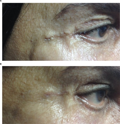 Figure 3 A 47-year-old female patient with recent postsurgical scar (blepharoplasty), before (A) and 3 months after laser treatment (B).