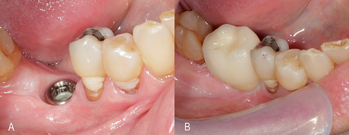 Figure 8 Clinical appearance after healing of the implant (A) and final prosthesis (B).