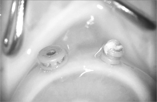 Figure 3 Intraoperative view of a valved (left) and a non-valved (right) cannula in a rabbit cadaver eye.